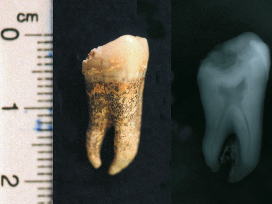 They were used as the study material Intact teeth extracted from three randomly selected dead in the Kerameikos mass grave